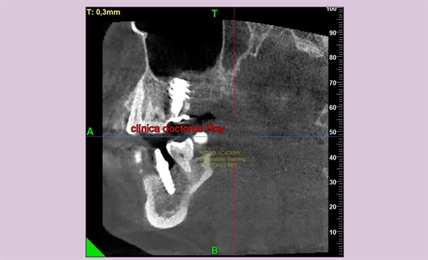 MONONOBLOCK IMPLANT DIAMETER 9 MM. IMPLANTES VALLADOLID, DR  ANTONIO REY GIL