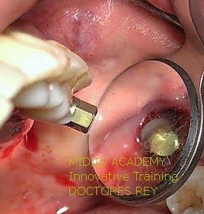 MONONOBLOCK IMPLANT DIAMETER 9 MM. IMPLANTES VALLADOLID, DR  ANTONIO REY GIL