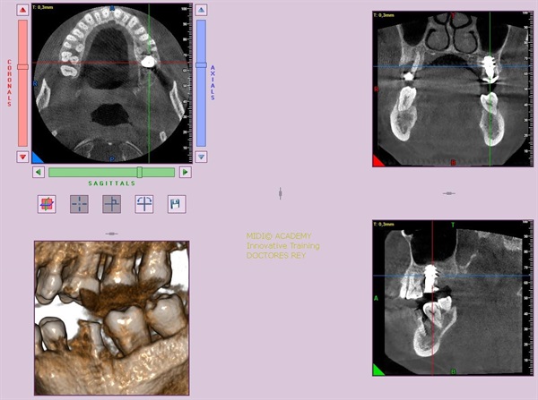 MONONOBLOCK IMPLANT DIAMETER 9 MM. IMPLANTES VALLADOLID, DR  ANTONIO REY GIL