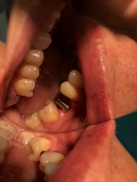 MONONOBLOCK IMPLANT DIAMETER 9 MM. IMPLANTES VALLADOLID, DR  ANTONIO REY GIL