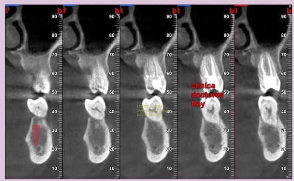 MONONOBLOCK IMPLANT DIAMETER 9 MM. IMPLANTES VALLADOLID, DR  ANTONIO REY GIL