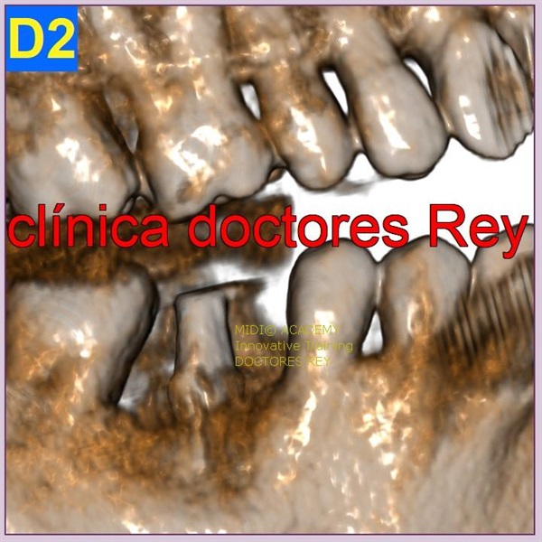 MONONOBLOCK IMPLANT DIAMETER 9 MM. IMPLANTES VALLADOLID, DR  ANTONIO REY GIL