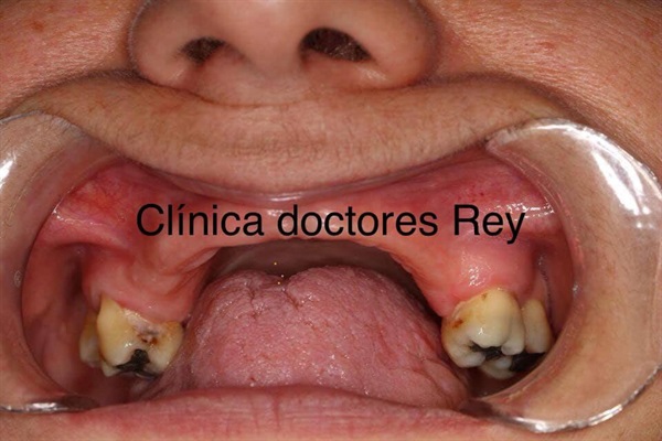 MIDI® Dr Rey Technique ultrason surgery, Dr Rey Gil