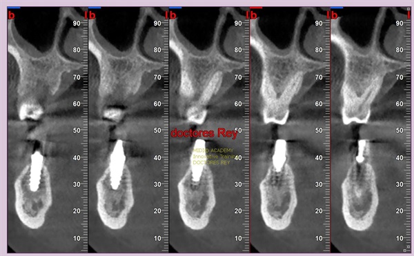 MONONOBLOCK IMPLANT DIAMETER 9 MM. IMPLANTES VALLADOLID, DR  ANTONIO REY GIL