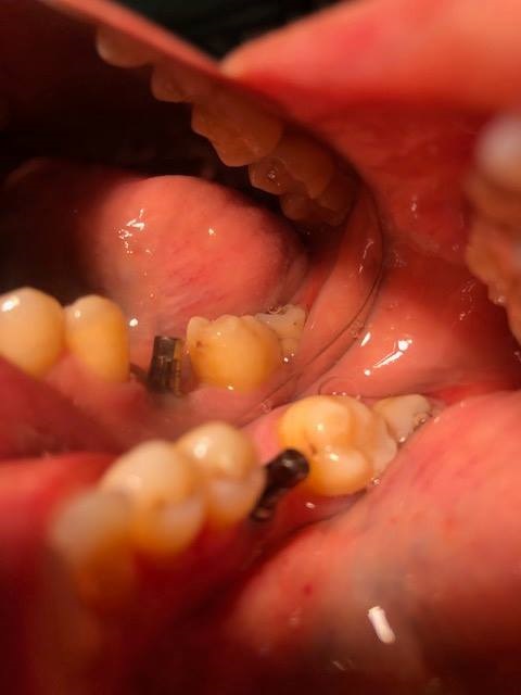 MONONOBLOCK IMPLANT DIAMETER 9 MM. IMPLANTES VALLADOLID, DR  ANTONIO REY GIL