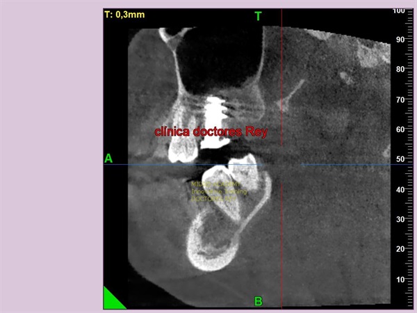 MONONOBLOCK IMPLANT DIAMETER 9 MM. IMPLANTES VALLADOLID, DR  ANTONIO REY GIL