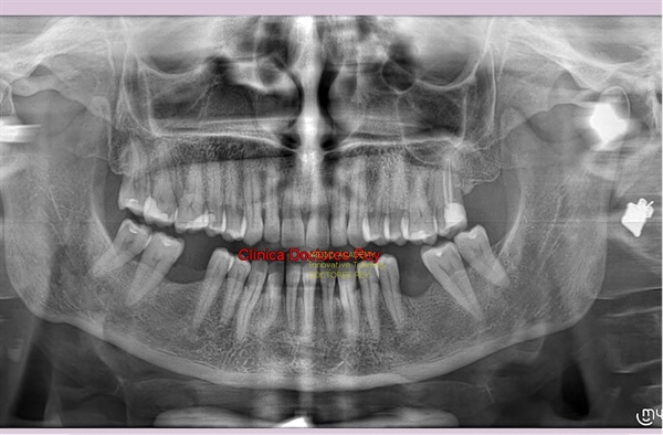 MONONOBLOCK IMPLANT DIAMETER 9 MM. IMPLANTES VALLADOLID, DR  ANTONIO REY GIL