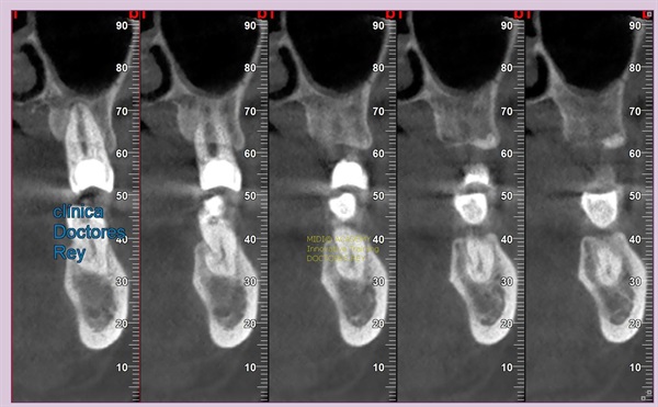 MONONOBLOCK IMPLANT DIAMETER 9 MM. IMPLANTES VALLADOLID, DR  ANTONIO REY GIL