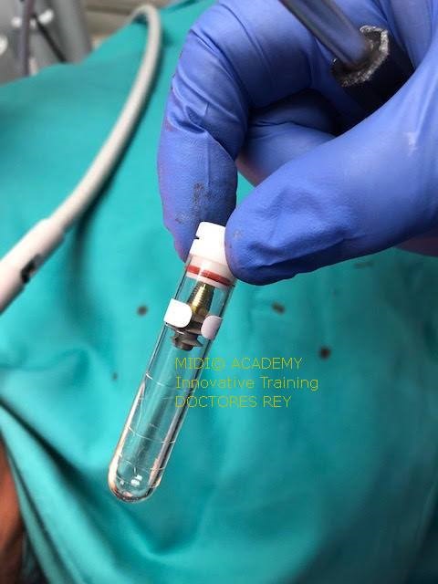 MONONOBLOCK IMPLANT DIAMETER 9 MM. IMPLANTES VALLADOLID, DR  ANTONIO REY GIL