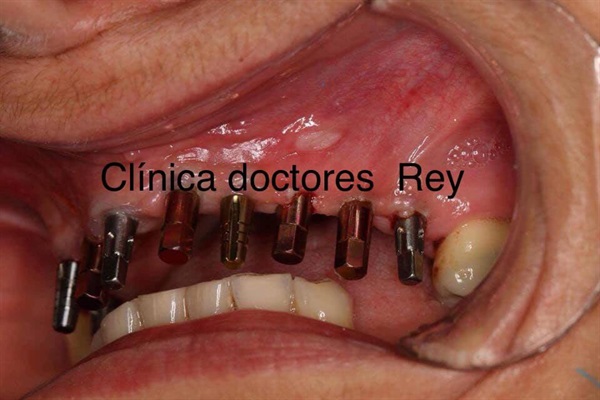 MIDI® Dr Rey Technique ultrason surgery, Dr Rey Gil
