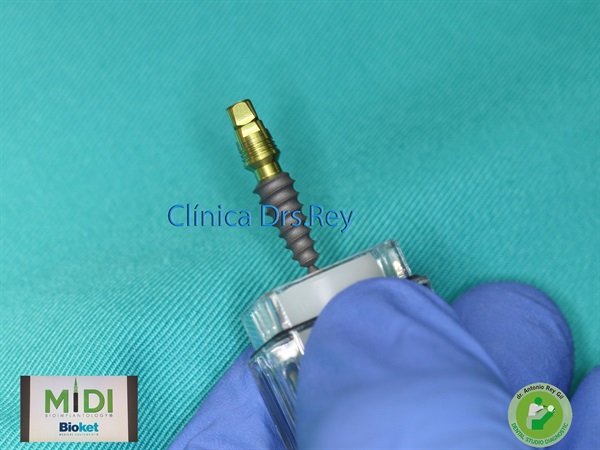 IMPLANTOLOGÍA DENTAL MÍNIMAMENTE INTEGRAL DR REY GIL