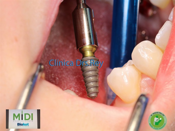 IMPLANTOLOGÍA DENTAL MÍNIMAMENTE INTEGRAL DR REY GIL