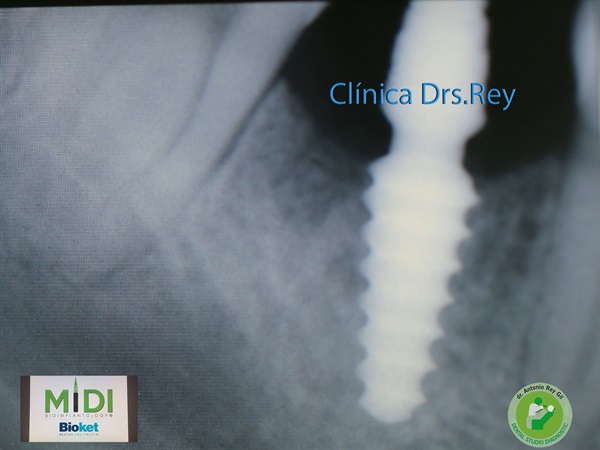 IMPLANTOLOGÍA DENTAL MÍNIMAMENTE INTEGRAL DR REY GIL