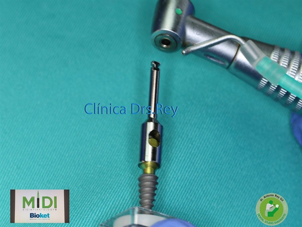 IMPLANTOLOGÍA DENTAL MÍNIMAMENTE INTEGRAL DR REY GIL