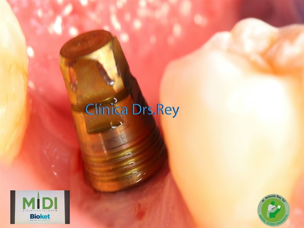 IMPLANTOLOGÍA DENTAL MÍNIMAMENTE INTEGRAL DR REY GIL