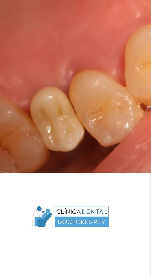 Implantes dentales Valladolid. Midi Técnica One piece implants Dr. Antonio Rey Gil