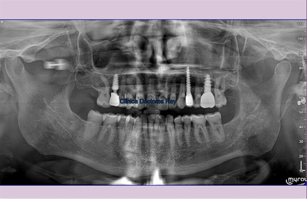 Implantes dentales Valladolid. Midi Técnica One piece implants Dr. Antonio Rey Gil