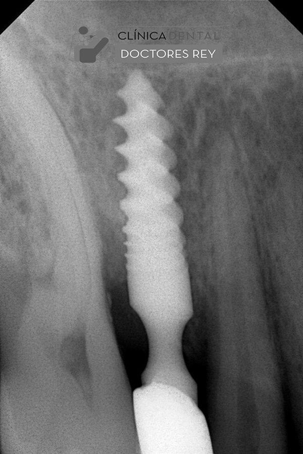 Implantes dentales Valladolid. Midi Técnica One piece implants Dr. Antonio Rey Gil