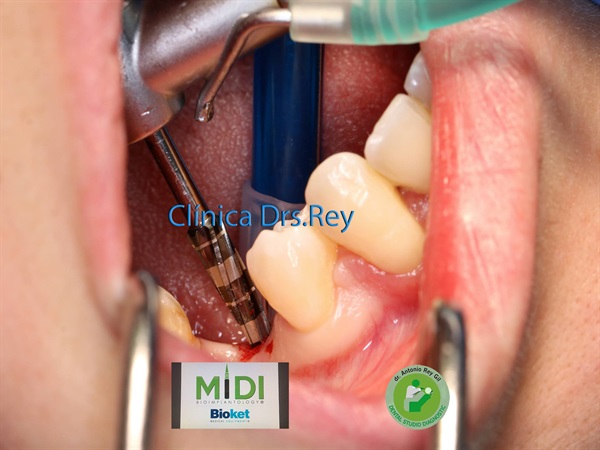IMPLANTOLOGÍA DENTAL MÍNIMAMENTE INTEGRAL DR REY GIL