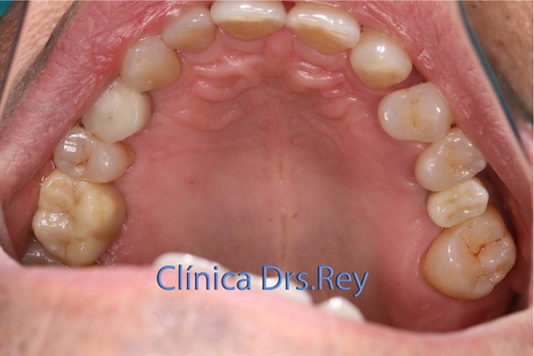 Implantes dentales Valladolid. Midi Técnica One piece implants Dr. Antonio Rey Gil