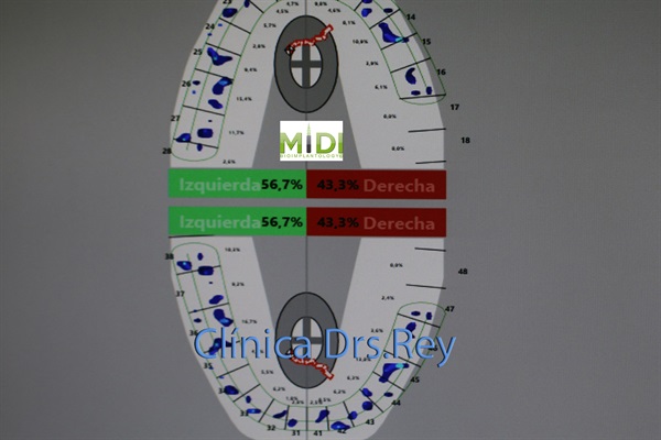 Implantes dentales Valladolid. Midi Técnica One piece implants Dr. Antonio Rey Gil