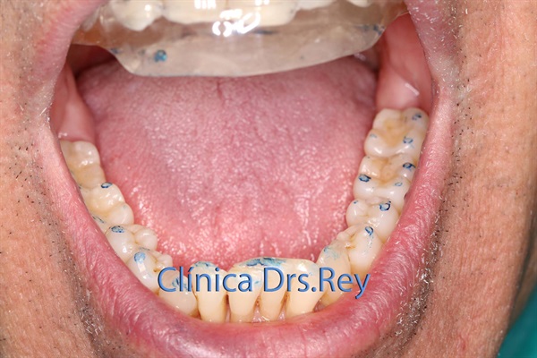 Implantes dentales Valladolid. Midi Técnica One piece implants Dr. Antonio Rey Gil