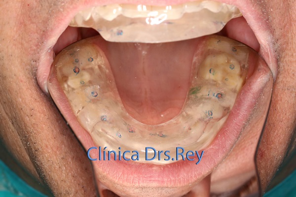 Implantes dentales Valladolid. Midi Técnica One piece implants Dr. Antonio Rey Gil