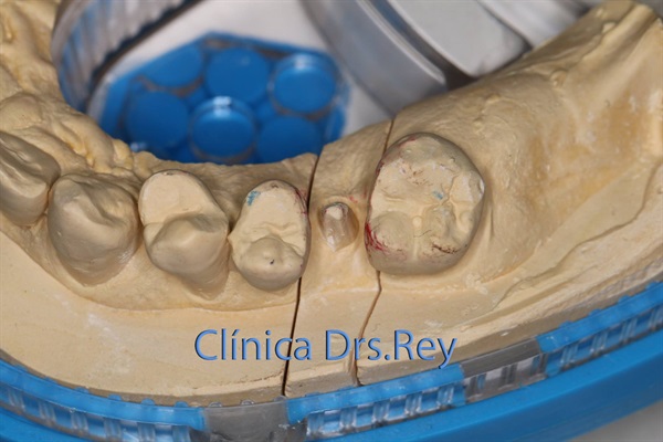 Implantes dentales Valladolid. Midi Técnica One piece implants Dr. Antonio Rey Gil