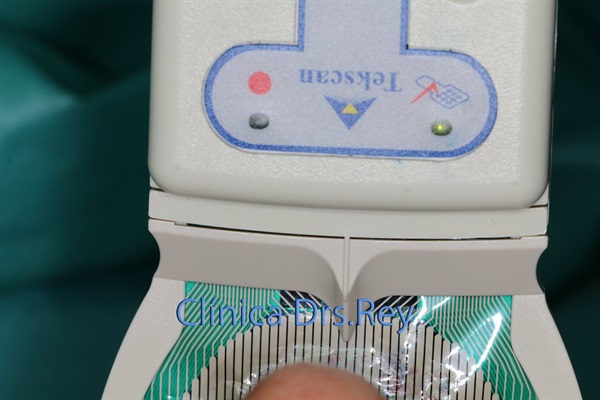 Implantes dentales Valladolid. Midi Técnica One piece implants Dr. Antonio Rey Gil