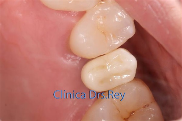 Implantes dentales Valladolid. Midi Técnica One piece implants Dr. Antonio Rey Gil