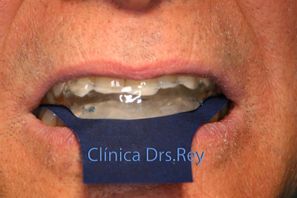 Implantes dentales Valladolid. Midi Técnica One piece implants Dr. Antonio Rey Gil