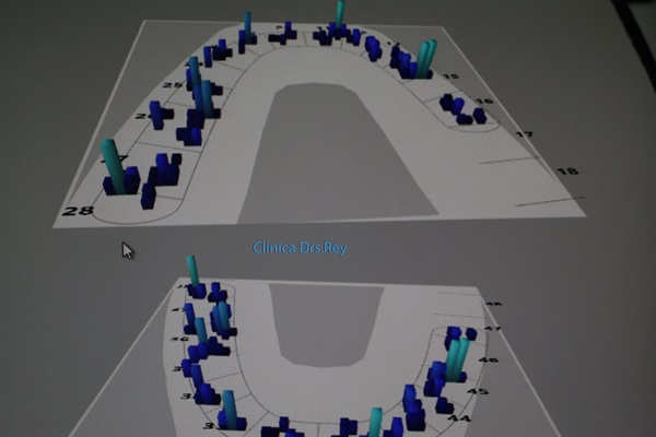 Implantes dentales Valladolid. Midi Técnica One piece implants Dr. Antonio Rey Gil