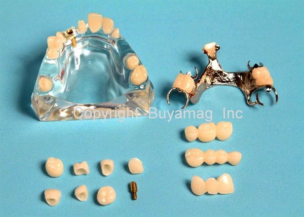 OUR ESTORATION DENTAL MODEL SHOWS VORIETY MOST FREQUENT TECHNIQUES COMBINATIONS USED BY DENTAL DOCTORS