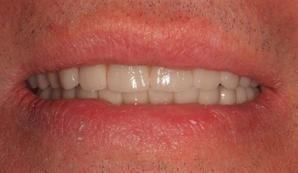 Upper and Lower Rehabilitation