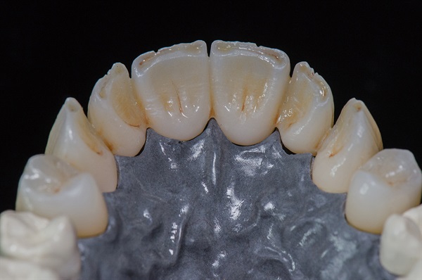 Monolithic Zirconia Closes the Link Between Digital Design and Bringing that Data into the Analog World