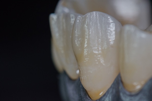 Monolithic Zirconia Closes the Link Between Digital Design and Bringing that Data into the Analog World