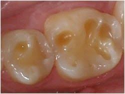 Want more sleep apnea patients....you have them as your general dental patients.  See the clinical signs of  sleep apnea
