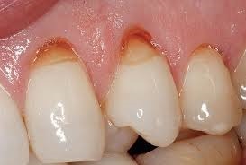 Want more sleep apnea patients....you have them as your general dental patients.  See the clinical signs of  sleep apnea