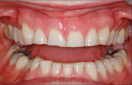 Want more sleep apnea patients....you have them as your general dental patients.  See the clinical signs of  sleep apnea