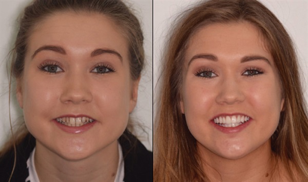 Before and After