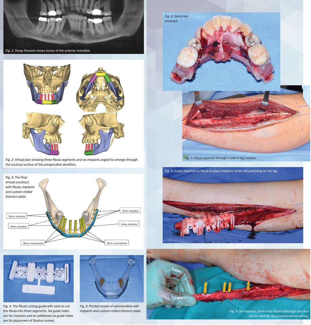 Building a Mandible