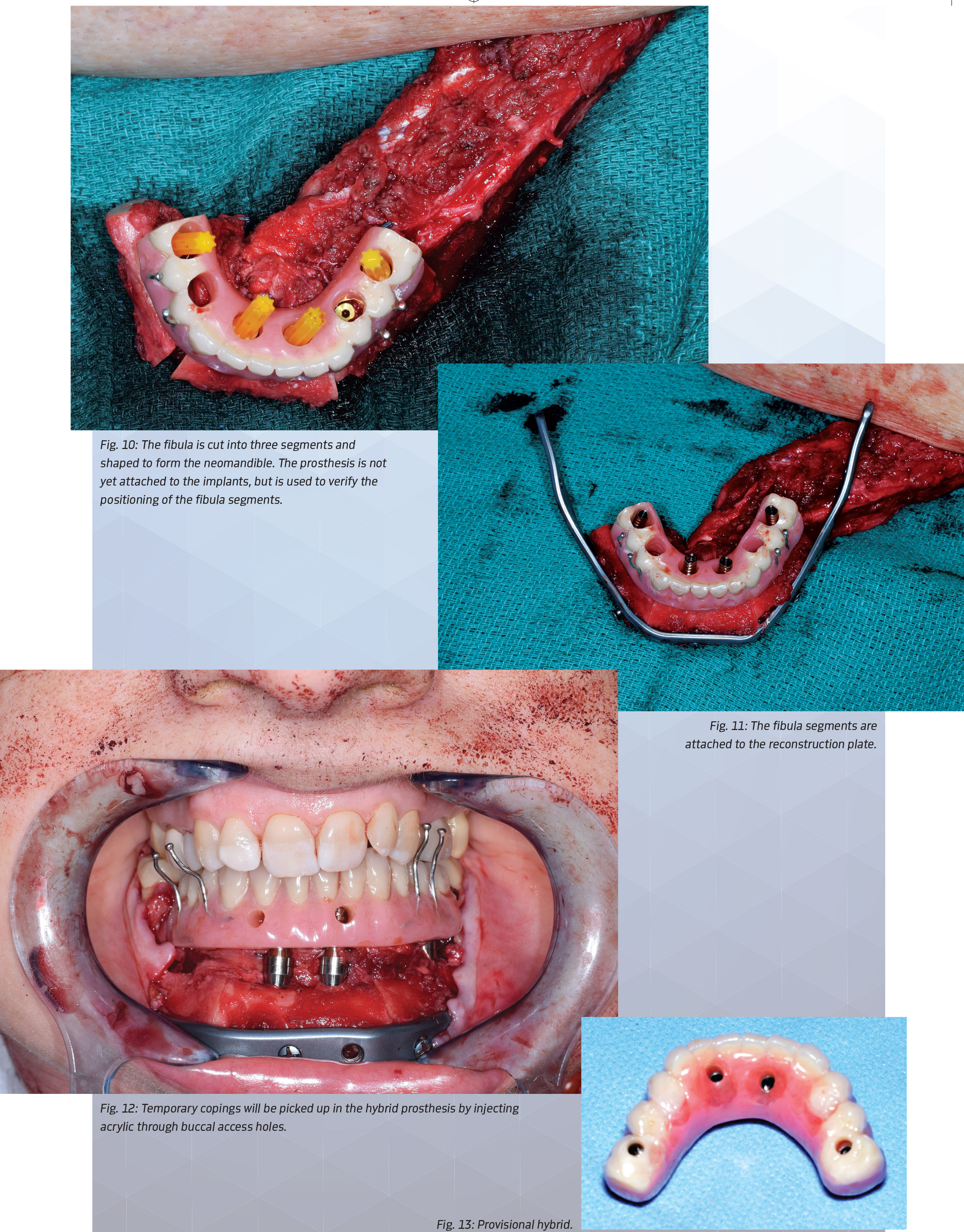 Building a Mandible