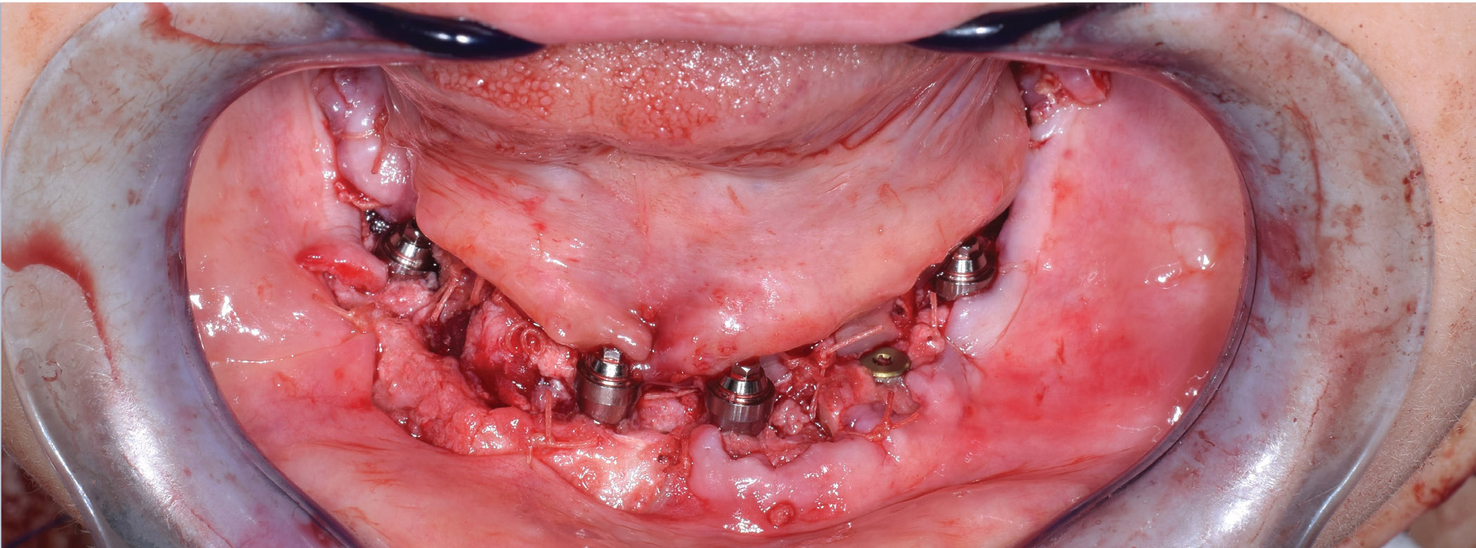 Building a Mandible