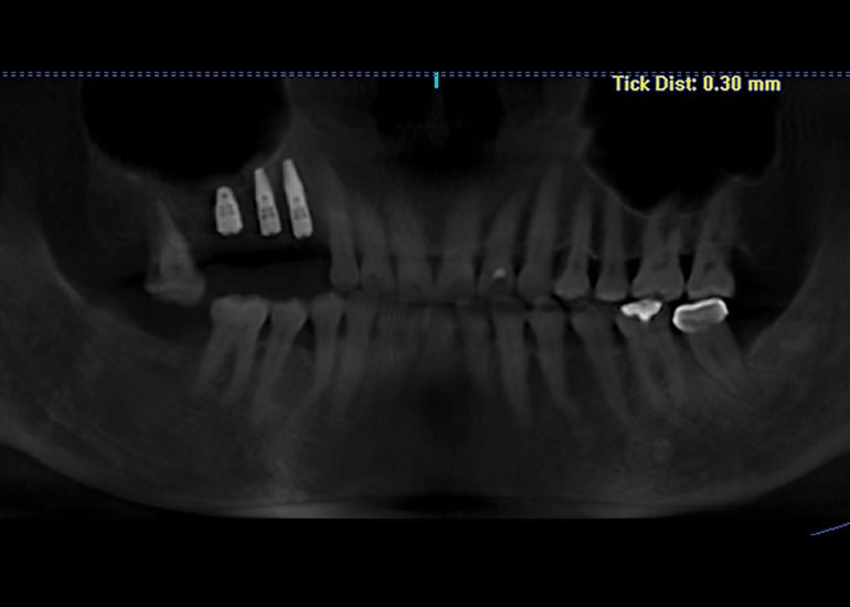 Robotic-Assisted Dental Implant Surgery
