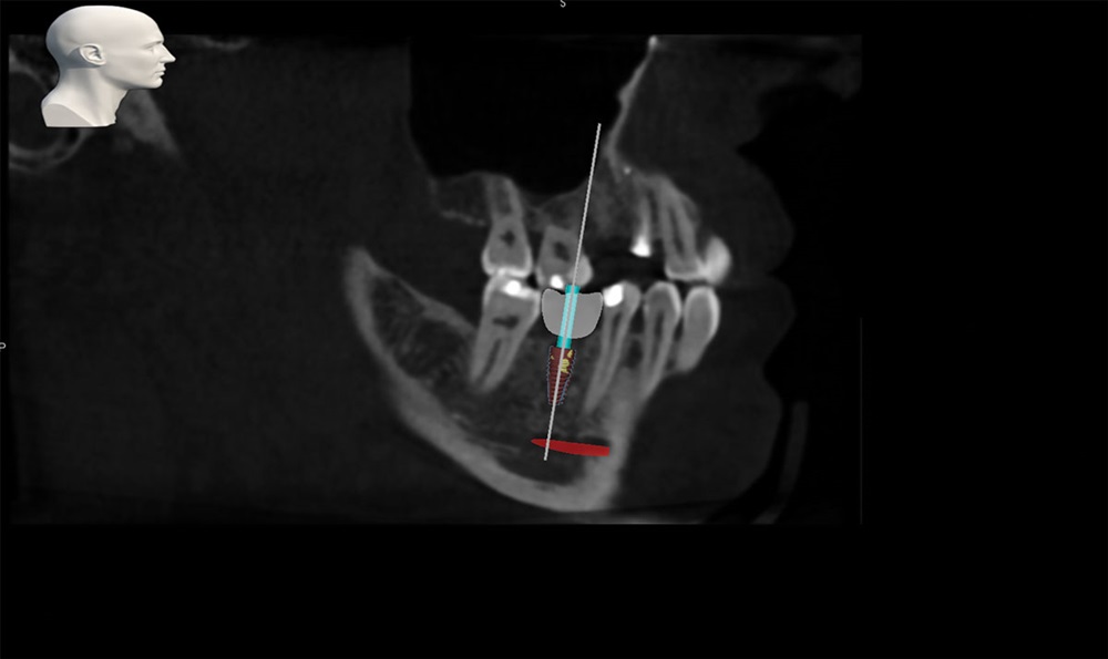 Robotic-Assisted Dental Implant Surgery