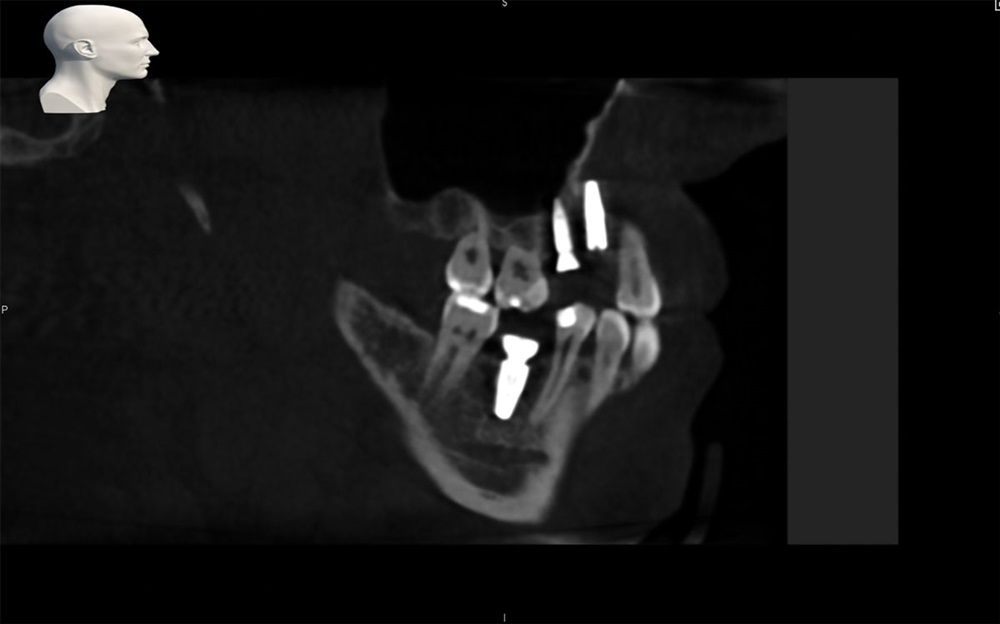 Robotic-Assisted Dental Implant Surgery