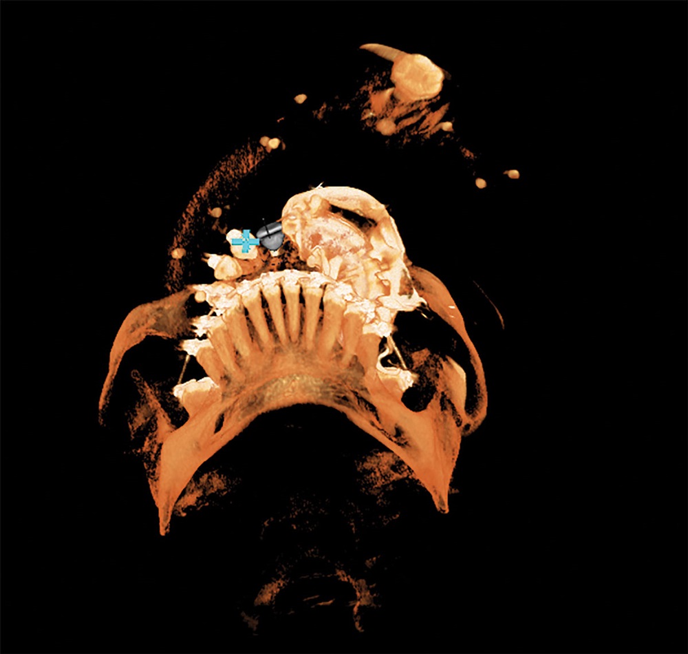 Robotic-Assisted Dental Implant Surgery