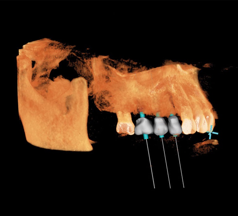 Robotic-Assisted Dental Implant Surgery