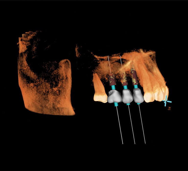 Robotic-Assisted Dental Implant Surgery