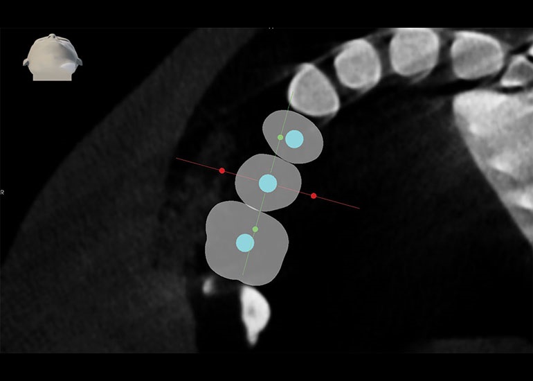 Robotic-Assisted Dental Implant Surgery